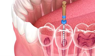 عوامل موثر در شکست درمان ریشه دندان
